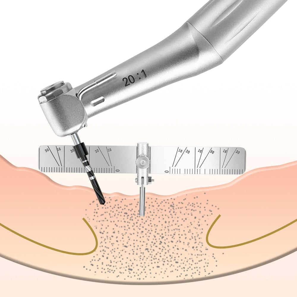 Guía de localización de implantes dentales
